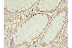 Immunohistochemistry of paraffin-embedded human colon cancer using ABIN7159891 at dilution of 1:100 (TIMM1 (AA 1-90) antibody)