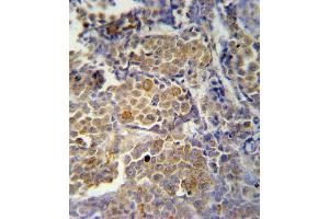 KIR2DS2 Antibody (Center) (ABIN651951 and ABIN2840473) immunohistochemistry analysis in formalin fixed and paraffin embedded human skin carcinoma followed by peroxidase conjugation of the secondary antibody and DAB staining. (KIR2DS2 antibody  (AA 39-65))