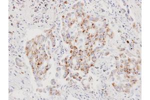 IHC-P Image Immunohistochemical analysis of paraffin-embedded human lung cancer, using AIF, antibody at 1:100 dilution. (AIF antibody  (N-Term))