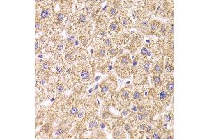 Immunohistochemistry of paraffin-embedded Human liver injury using ST3GAL3 antibody at dilution of 1:100 (x400 lens). (ST3GAL3 antibody)