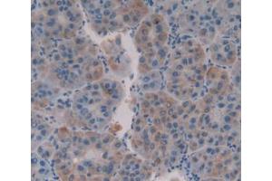 IHC-P analysis of Human Liver Cancer Tissue, with DAB staining. (MUC16 antibody  (AA 13977-14117))