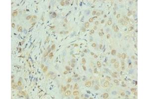Immunohistochemistry of paraffin-embedded human liver cancer using ABIN7156933 at dilution of 1:100 (IL-8 antibody  (AA 23-99))