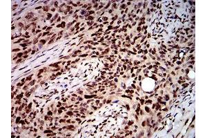 Immunohistochemical analysis of paraffin-embedded cervical cancer tissues using DDX1 mouse mAb with DAB staining. (DDX1 antibody  (AA 642-740))