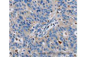 Immunohistochemistry of Human lung cancer using GRIA3 Polyclonal Antibody at dilution of 1:50 (Glutamate Receptor 3 antibody)