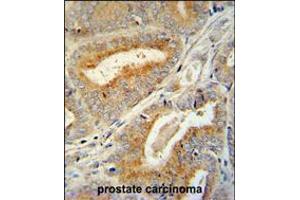 BCORL1 antibody immunohistochemistry analysis in formalin fixed and paraffin embedded human prostate carcinoma followed by peroxidase conjugation of the secondary antibody and DAB staining. (BCORL1 antibody  (N-Term))