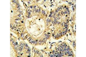IHC analysis of FFPE human colon carcinoma stained with SOCS1 antibody (SOCS1 antibody  (AA 35-66))