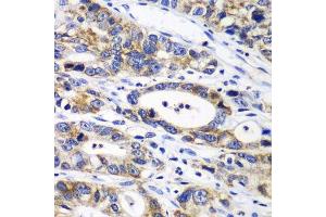 Immunohistochemistry of paraffin-embedded human gastric cancer using RPN1 antibody.