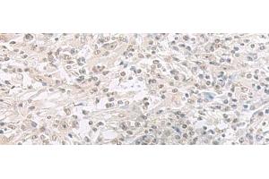 Immunohistochemistry of paraffin-embedded Human liver cancer tissue using ORC1 Polyclonal Antibody at dilution of 1:65(x200) (ORC1 antibody)