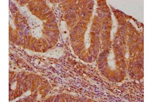 IHC image of ABIN7140215 diluted at 1:640 and staining in paraffin-embedded human colon cancer performed on a Leica BondTM system. (Vasn antibody  (AA 553-572))