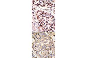 (TOP)Formalin-fixed and paraffin-embedded human cancer tissue reacted with the primary antibody, which was peroxidase-conjugated to the secondary antibody, followed by DAB staining. (ERK1 antibody  (N-Term))