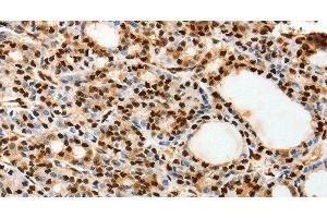 Immunohistochemistry of paraffin-embedded Human thyroid cancer using SPATA20 Polyclonal Antibody at dilution of 1:70 (SPATA20 antibody)