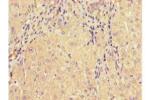 Immunohistochemistry of paraffin-embedded human liver cancer using ABIN7159734 at dilution of 1:100 (MTTP antibody  (AA 19-151))