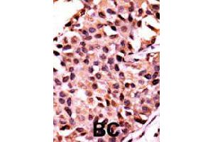 Formalin-fixed and paraffin-embedded human breast cancer tissue reacted with PPP3CC polyclonal antibody  , which was peroxidase-conjugated to the secondary antibody, followed by AEC staining. (PPP3CC antibody  (N-Term))