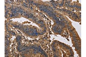 The image on the left is immunohistochemistry of paraffin-embedded Human colon cancer tissue using ABIN7191171(KCNG1 Antibody) at dilution 1/40, on the right is treated with synthetic peptide.