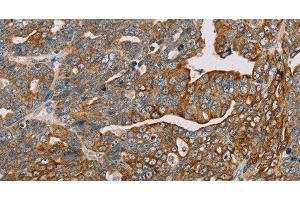 Immunohistochemistry of paraffin-embedded Human cervical cancer using MTFP1 Polyclonal Antibody at dilution of 1:30 (Mtfp1 antibody)