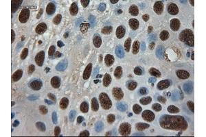 Immunohistochemical staining of paraffin-embedded Adenocarcinoma of breast using anti-AMY2A (ABIN2452539) mouse monoclonal antibody.