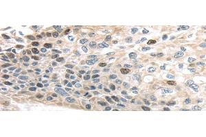 Immunohistochemistry of paraffin-embedded Human esophagus cancer using TPX2 Polyclonal Antibody at dilution of 1/40 (TPX2 antibody)