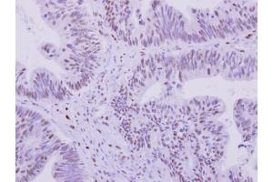 IHC-P Image 53BP1 antibody [N1], N-term detects 53BP1 protein at nucleus on human colon carcinoma by immunohistochemical analysis. (TP53BP1 antibody  (N-Term))