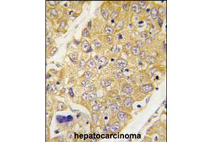 Formalin-fixed and paraffin-embedded human hepatocellular carcinoma reacted with Dtnbp1 polyclonal antibody  , which was peroxidase-conjugated to the secondary antibody, followed by DAB staining. (DTNBP1 antibody  (C-Term))