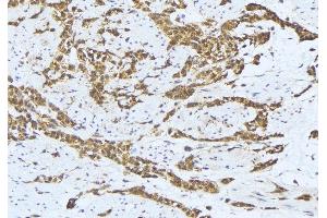 ABIN6275640 at 1/100 staining Human lung cancer tissue by IHC-P. (MTERF antibody  (Internal Region))