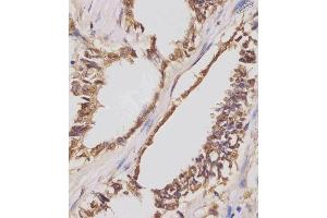(ABIN654423 and ABIN2844158) staining IGF2BP1 in human lung adenocarcinoma sections by Immunohistochemistry (IHC-P - paraformaldehyde-fixed, paraffin-embedded sections).