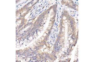 Immunohistochemistry of paraffin-embedded human colon carcinoma using SARA Rabbit mAb (ABIN7271559) at dilution of 1:50 (40x lens).