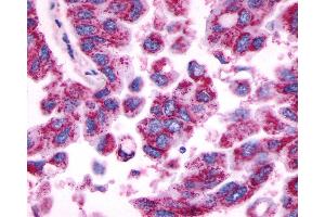 Anti-MRGPRE / MRGE antibody IHC of human Lung, Adenocarcinoma. (MRGPRE antibody  (C-Term))