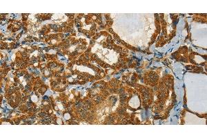 Immunohistochemistry of paraffin-embedded Human thyroid cancer tissue using NPAP1 Polyclonal Antibody at dilution 1:60 (NPAP1 antibody)