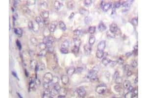 Immunohistochemistry analyzes of C-Raf antibody in paraffin-embedded human breast carcinoma tissue. (RAF1 antibody)