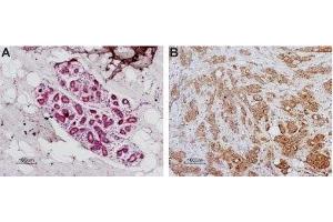 Expression of PAR-1 in normal human breast and human breast carcinoma - Immunohistochemical staining of paraffin-embedded human breast sections using Anti-Human PAR1 (F2R) (extracellular) Antibody (ABIN7043073, ABIN7045102 and ABIN7045103), (1:100). (PAR1 antibody  (Extracellular, N-Term))
