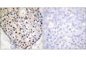 Immunohistochemistry analysis of paraffin-embedded human breast carcinoma, using CHOP (Phospho-Ser30) Antibody. (DDIT3 antibody  (pSer30))