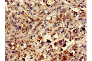 Immunohistochemistry of paraffin-embedded human melanoma using ABIN7154456 at dilution of 1:100 (PLA2G1 (AA 43-165) antibody)