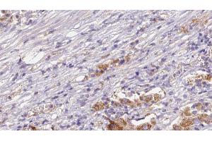 ABIN6272632 at 1/100 staining Human liver cancer tissue by IHC-P. (CD300LB antibody  (C-Term))
