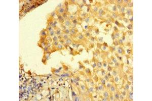 Immunohistochemistry of paraffin-embedded human breast cancer using ABIN7168626 at dilution of 1:100 (STIL antibody  (AA 388-637))