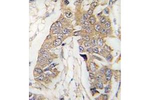 Formalin-fixed and paraffin-embedded human breast carcinoma tissue reacted with CASC3 Antibody (C-term) , which was peroxidase-conjugated to the secondary antibody, followed by DAB staining.