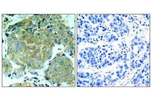 Immunohistochemical analysis of paraffin-embedded human breast carcinoma tissue using eIF2α (Phospho-Ser51) Antibody (left) or the same antibody preincubated with blocking peptide (right). (EIF2S1 antibody  (pSer51))