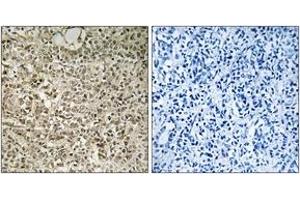 Immunohistochemistry analysis of paraffin-embedded human breast carcinoma tissue, using RPL40 Antibody.