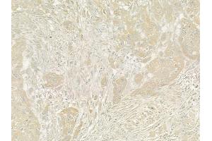 ABIN6260408 and ABIN6273204 at 1/100 staining human tongue carcinoma by IHC-P. (CALCOCO2 antibody  (Internal Region))