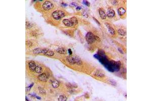 Immunohistochemical analysis of JNK2 staining in human lung cancer formalin fixed paraffin embedded tissue section. (JNK2 antibody  (Center))