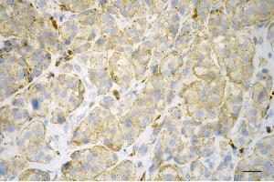 Immunohistochemistry was performed on paraffin-embedded human melanoma using ITGB1BP1 antibody (ABIN7799068), 1:200).