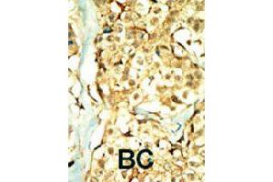 Formalin-fixed and paraffin-embedded human cancer tissue reacted with TNIK polyclonal antibody  , which was peroxidase-conjugated to the secondary antibody, followed by DAB staining.
