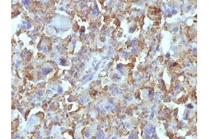 Formalin-fixed, paraffin-embedded human Histiocytoma stained with Macrophage Monoclonal Antibody (D11). (Macrophage / Histiocytoma Marker antibody)