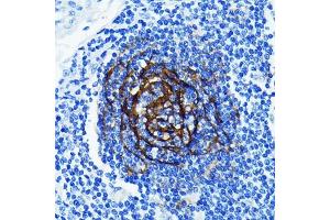 Immunohistochemistry of paraffin-embedded human lung cancer using p75NTR/NGFR Rabbit mAb (ABIN7268850) at dilution of 1:100 (40x lens). (NGFR antibody)