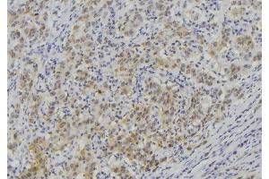 ABIN6273513 at 1/100 staining Human lung cancer tissue by IHC-P. (LAMC3 antibody  (Internal Region))