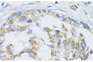 Immunohistochemistry of paraffin-embedded Human mammary cancer using SLC30A1 Polyclonal Antibody at dilution of 1:100 (40x lens). (SLC30A1 antibody)