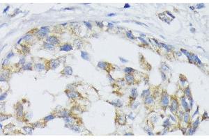 Immunohistochemistry of paraffin-embedded Human mammary cancer using SLC30A1 Polyclonal Antibody at dilution of 1:100 (40x lens).