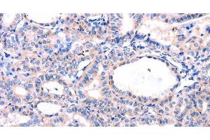 Immunohistochemistry of paraffin-embedded Human thyroid cancer tissue using DUSP12 Polyclonal Antibody at dilution 1:77 (DUSP12 antibody)