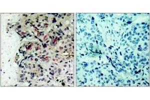 Immunohistochemistry analysis of paraffin-embedded human breast carcinoma tissue, using JAK1 (Ab-1022) Antibody. (JAK1 antibody  (AA 988-1037))