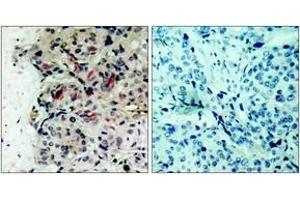 Immunohistochemistry analysis of paraffin-embedded human breast carcinoma tissue, using JAK1 (Ab-1022) Antibody.