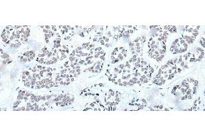 Immunohistochemistry of paraffin-embedded Human esophagus cancer tissue using BRD3 Polyclonal Antibody at dilution of 1:60(x200) (BRD3 antibody)